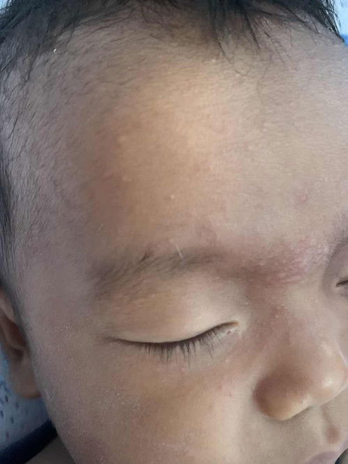 มีผื่นขึ้นตามหน้าตามตัวตั้งแต่หายไข้เรียกว่าส่าไข้หรือหัดไหมคะ