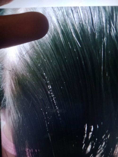 ผมเป็นเม็ดๆ ใช้อะไรดีค่ะ แนะนำหน่อยค่ะ