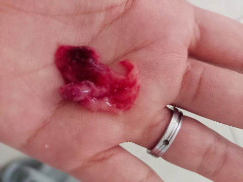 Gumpalan darah seperti keguguran