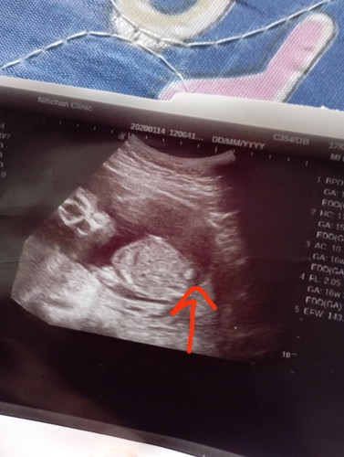 16w+3d เพศน้องยังไม่ชัด