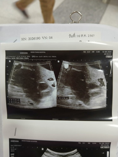 มีใครตั้งครรภ์อยู่แล้วแล้วตรวจเจอว่า มีซีสต์ที่รังไข่ปีกขาวบ้สงไหมค่ะ อันตรายไหม กังวลจัง