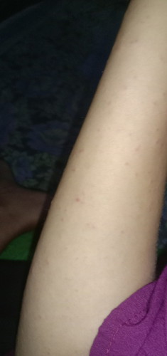 Mau tanya ada gak bumil tm 2 bintik-bintik merah sebadan??