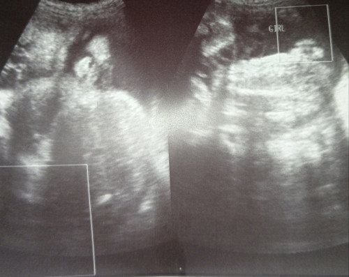 Ultrasound