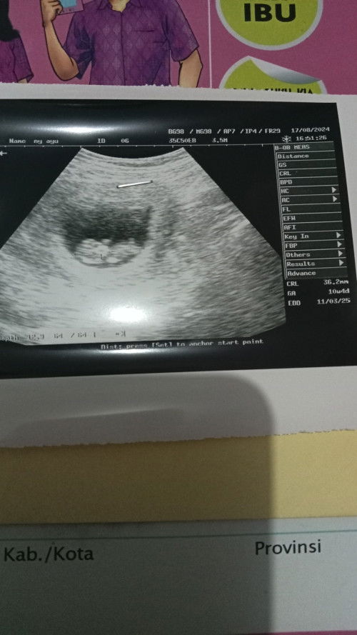 Hpht 4 juni ( 10w4d)