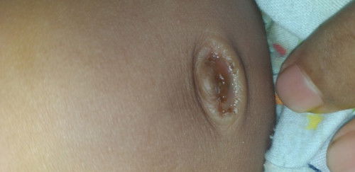 Bun anaku umur 1 bulan pusarx berair keruh kayak campur nanah tapi gak bau mohon solusinx bun🙏