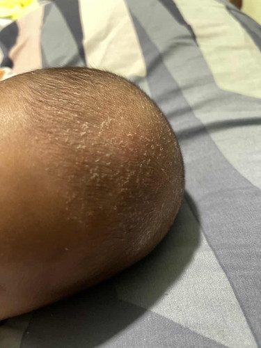 dry and flaky scalp