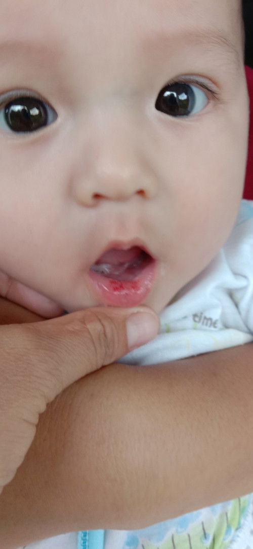 Bunda bayi ku sudah 4 bulan 13 hari,tapi sekarang lagi sariawan apa ada bund yang pernah mengalami.