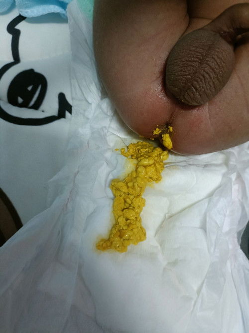 น้องถ่ายแบบนี้ปกติไหมคะ