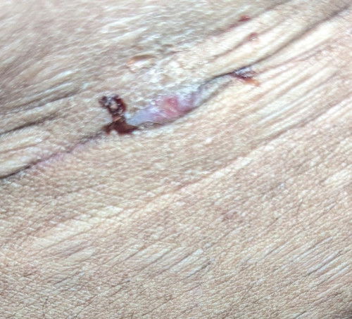 Luka sc berdarah dan pedih