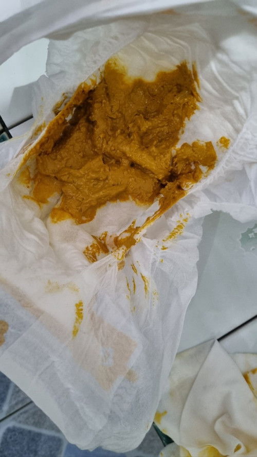 Bunda2 saya mau tanya tentang bab bayi 2 bulan 6 hari berwarna kuning gelap dan lengket normal ga ya