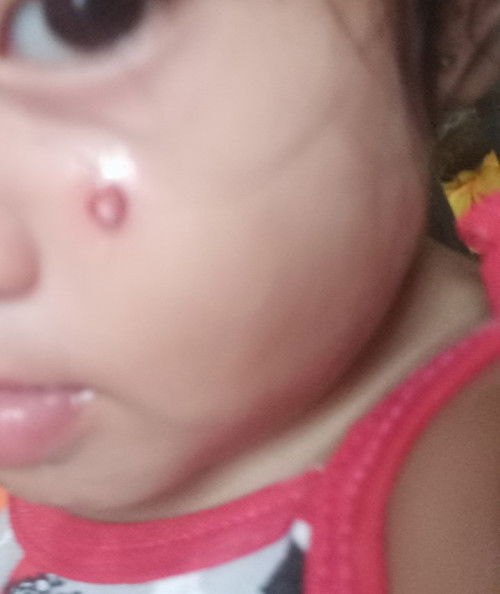 Paano madaling mapagaling at matanggal po ang peklat kung sakali kalmot malalim