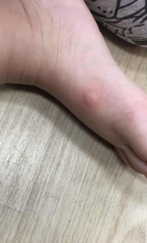 Red bump on baby’s leg