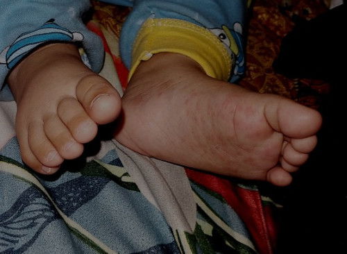 Bentol kecil di telapak kaki anak