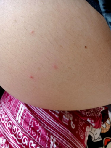 มีใครเป็นตุ่มแดงๆ ขึ้นแบบนี้บ้างคะ