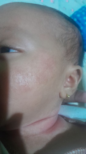 Kulit bayi kasar ruam merah