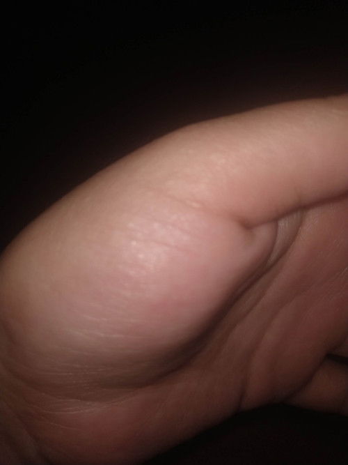 Setelah menyapih Seluruh badanku Gatal, telapak tangan banyak lenting2 kecil kaya Kuman air