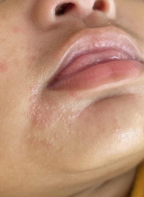 Bayi alergi di sekitar mulut