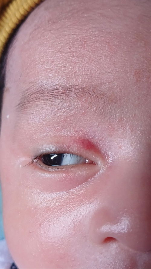 Merah di kelopak mata bayi