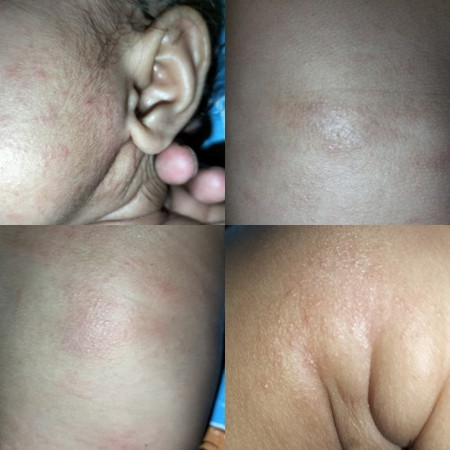 BINTIK BINTIK MERAH KULIT BAYI.
biasanya karena apa dan cara ngobatinnya gmn yah?? πππ