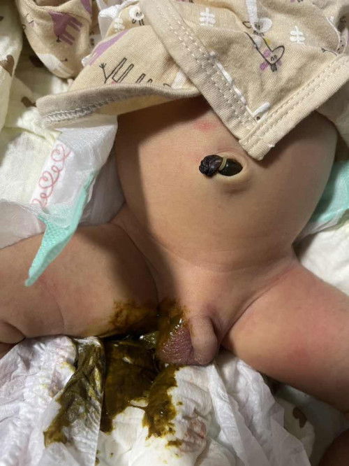 น้องอายุ 5 วัน ถ่ายเหลวๆเป็นสีเขียวๆ เหลืองๆเหมือนในรูป นี้เป็นอันตรายไหมคะ (ให้กินนมแม่ + นมผงไฮคิว) น้องไม่งอแงค่ะ