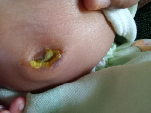 แบบนี้คืออักเสบไหมคะ