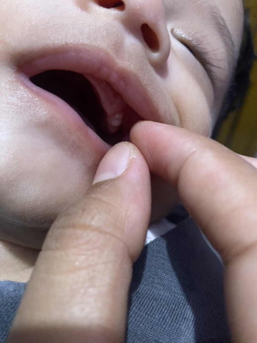 Benjolan putih digusi bayi,dari nb sampe sekarang umur 4 blan masih ada