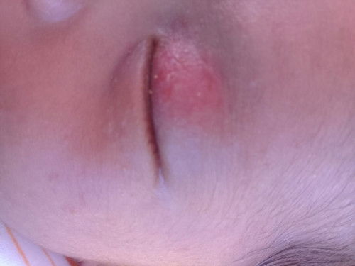 Bun, ada yang kelopak mata bayi new bornya merah kayak gini? Ini kenapa ya?