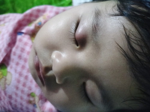 Sakit mata bayi
