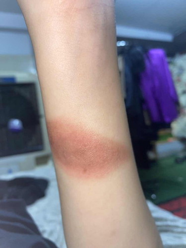 Cara keringkan luka + gatal
