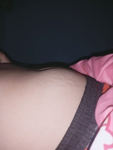 หน้าท้องลาย