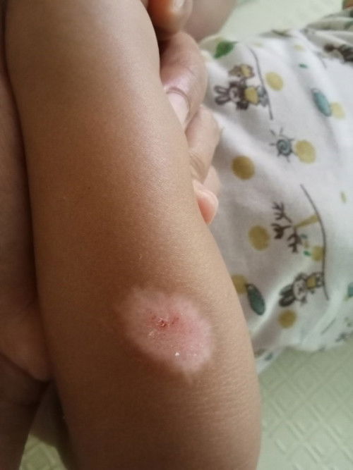 Menghilangkan bekas luka