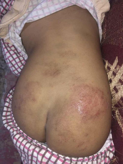 SOLUSI RUAM POPOK ANAK 2 TAHUN 😭