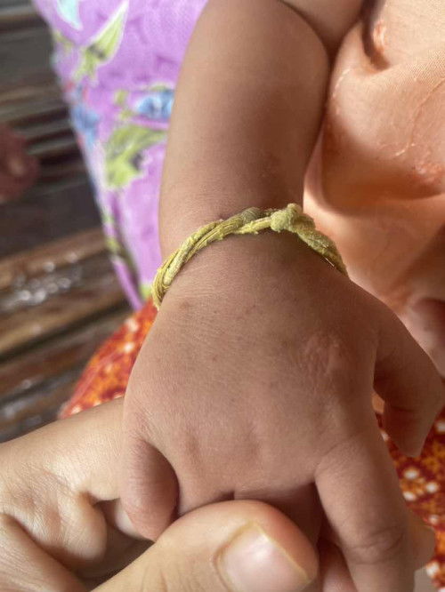 ผื่นแดงงจ้ำๆเหมือนเลือด