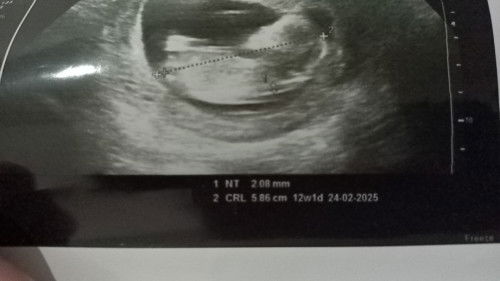 Crl berbeda dr usia kehamilan