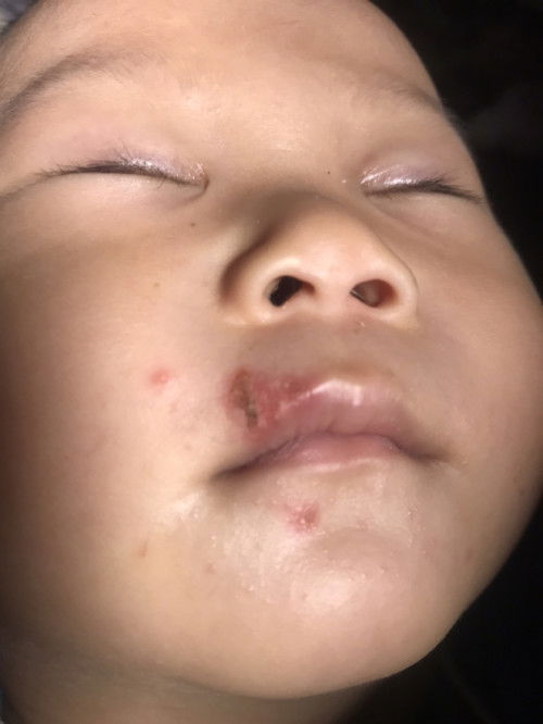 ลูก8เดือนเป็นแบบบริเวณปากค่ะ อาการแรกเริ่มคือน้องเป็นตุ่มนูนแดงตุ่มเดียวหลังจากนั้น3วันเริ่มเป็นแผลค่ะ ตอนนี้แผลเริ่มลามแล้วค่ะ