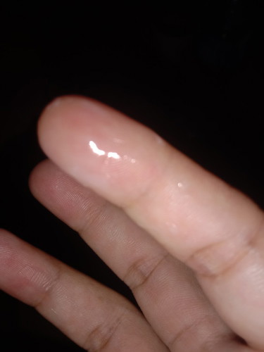 ท้อง38+5   มีอาการเจ็บท้อง