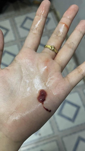 Pregnancy 9 week 5 d