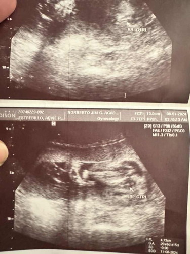 Gender ultrasound
