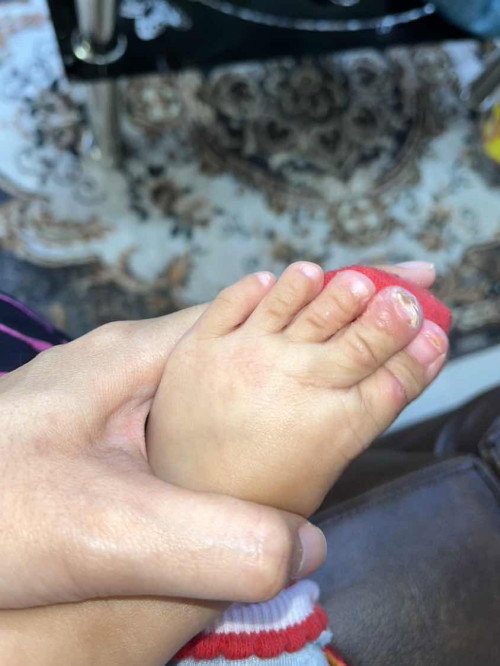 Gatal bernanah pada bayi 10 bulan