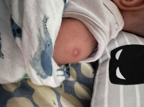 Tempat injection bernanah