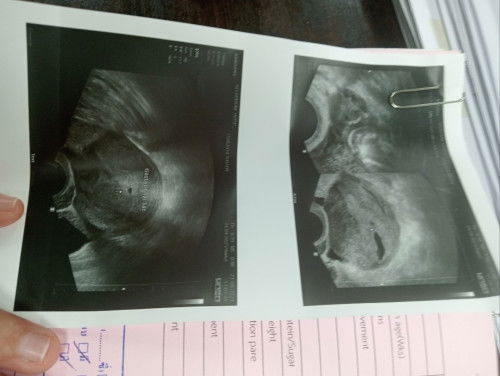 อัลตร้าซาวด์ครั้งแรก 5W