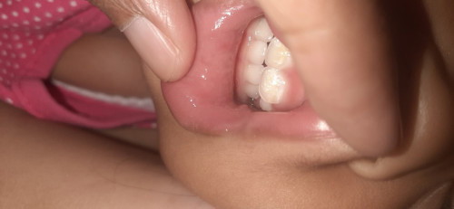 Serius tanya ya mams..ini cara ngatasinya gmn ya??uda muncul plak.usia 23bulan