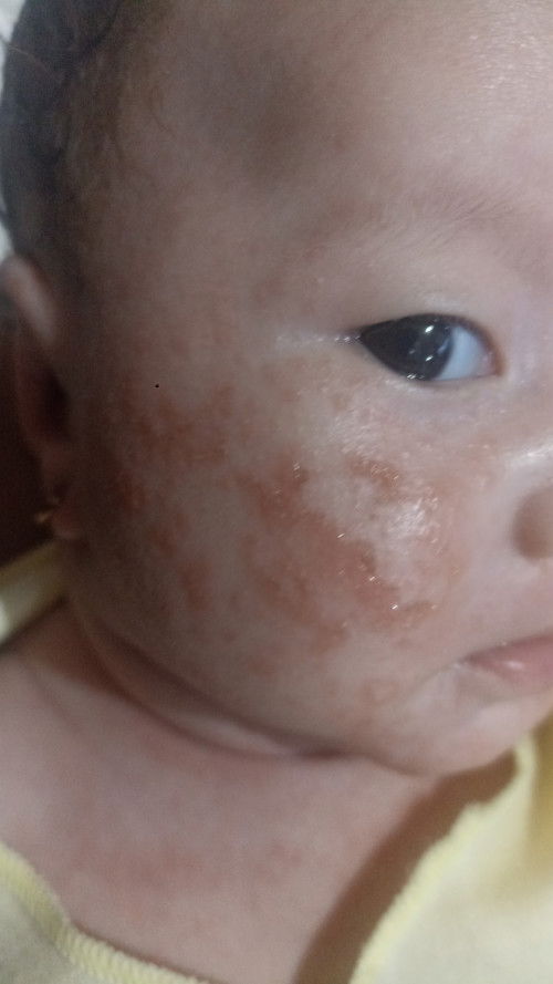 Pipi merah berair kenapa ya??? Ruam di pipi atau ap ya???