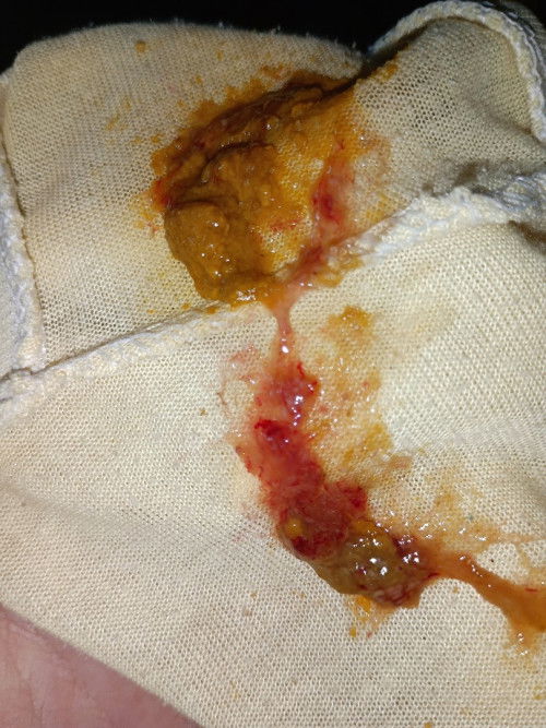 Bab berlendir dan berdarah