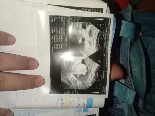 น้ำหนักลูกน้อยกว่าเกณฑ์