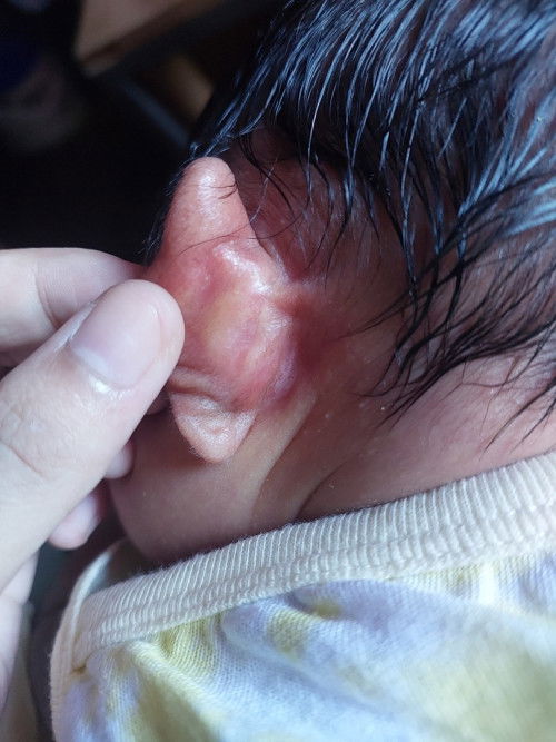 SUGAT SA LIKOD NG TENGA. 2 WEEKS OLD BABY