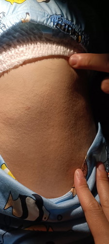 Heat Rashes?