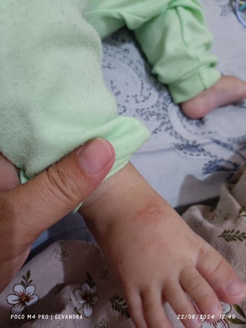 Bayi 7bulan beruntusan air