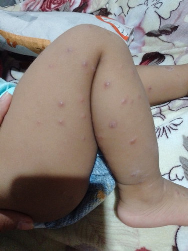 ano po kaya itong tumubo sa anak ko ang dami nya na nagka tatlong pedia na kami pero ganun padin po.