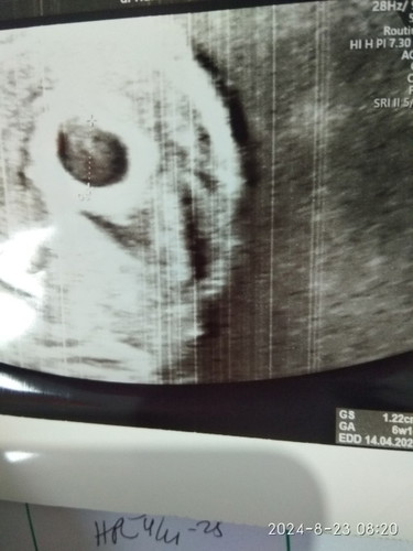 Dokter bilang , saya divonis BO , harus dikuret..... Ada yang samaan ga bun